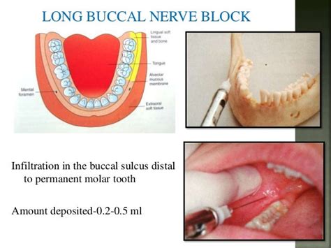 Mandibular nerve blocks techniques