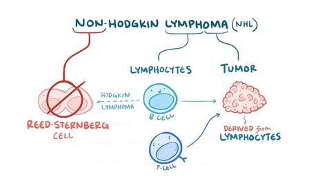 Non-Hodgkin lymphoma: Video, Anatomy & Definition | Osmosis