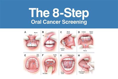 Mouth Cancer Symptoms, Risks and Checkup | Bow Lane Dental Group