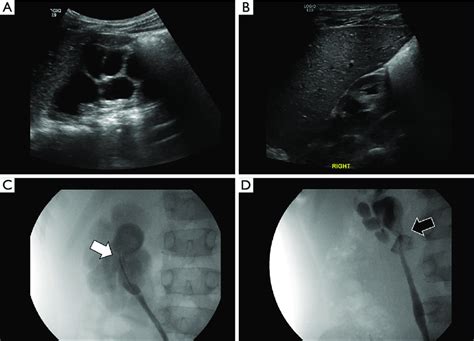 Retrograde ureteropyelography images. (A,B) Postoperative improvement ...