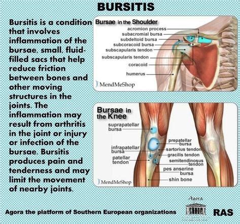 An explanation of bursitis. | Bursitis