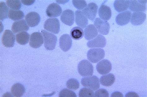 Free picture: clinical, presentation, vary, substantially, depending, infecting, level, parasitemia