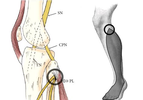 Common peroneal nerve entrapment. Left -entrapment of the common... | Download Scientific Diagram