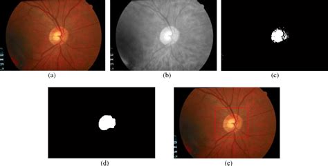 Figure 4 from Automated Glaucoma Detection using Cup to Disc Ratio ...