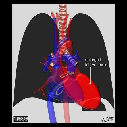 What Causes Lateral Ventricular Enlargement - Best Design Idea