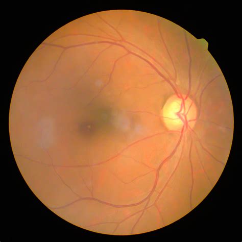 Normal-Tension Glaucoma: What's the Difference?