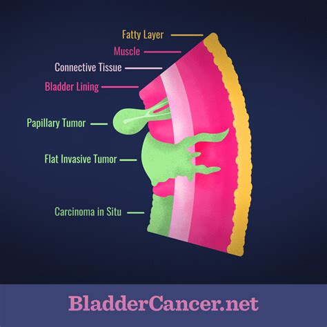 Bladder Cancer Tumor