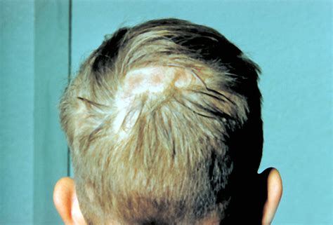 Public Domain Picture | This image shows a patient with ringworm of the scalp, 'tinea capitis ...