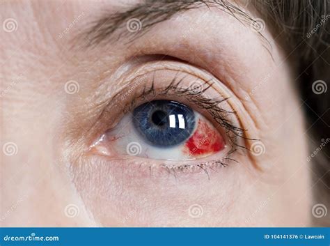 Eye. Conjunctiva And Sclera Stock Image | CartoonDealer.com #220382497