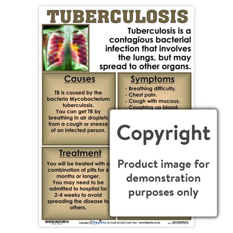 Tuberculosis (TB) Chart - Play School Room CC