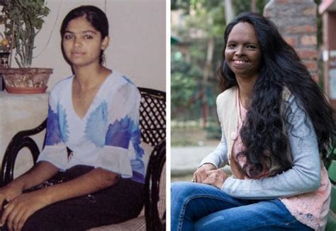 Laxmi Agarwal - The Real Fighter of Acid Attack | Success Story