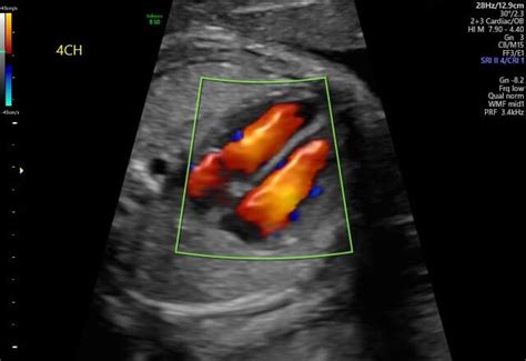 Fetal Echocardiography | Johns Hopkins Division of Maternal-Fetal Medicine