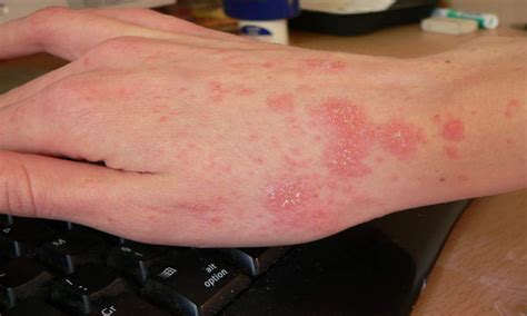 Scabies rash Look Like & Causes10