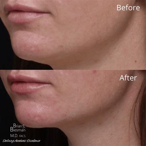 Jawline Contouring and Slimming: Jawline Filler or Jawline Botox? - Brian S. Biesman M.D.