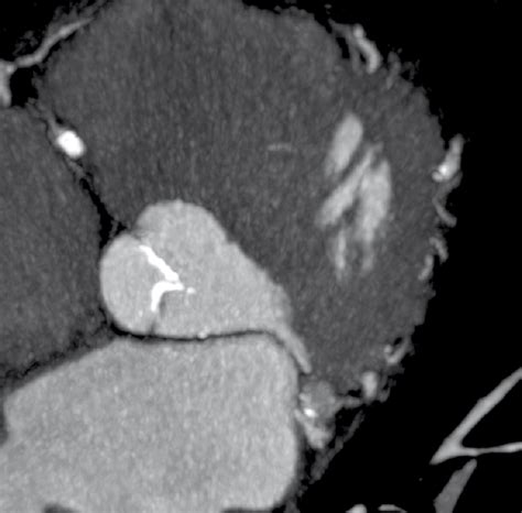 Calcification of aortic valve leaflets shown in multi-slice computed ...