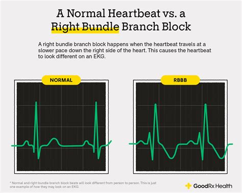 RBBB and EKGs: Diagnosing Right Bundle Branch Blocks - GoodRx