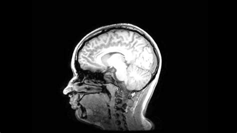 What Does A Brain Scan Look Like at Madeline McDonald blog