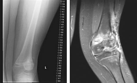 Genu valgum (knock-knees): Causes and treatment