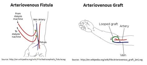 Icd 10 Code For Av Fistula Malfunction