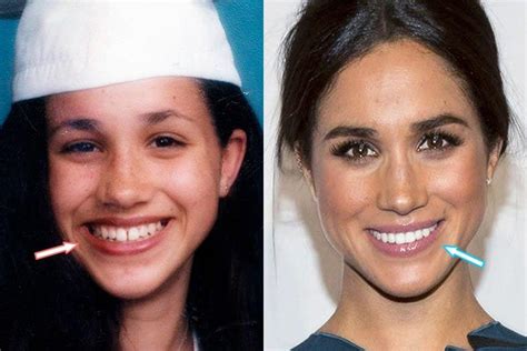 HOW CAN I GET A SMILE LIKE MEGHAN MARKLE? | Bespoke Smile