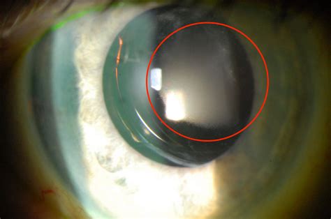 Moran CORE | Intraocular Lens (IOL) Opacification and Calcification in ...