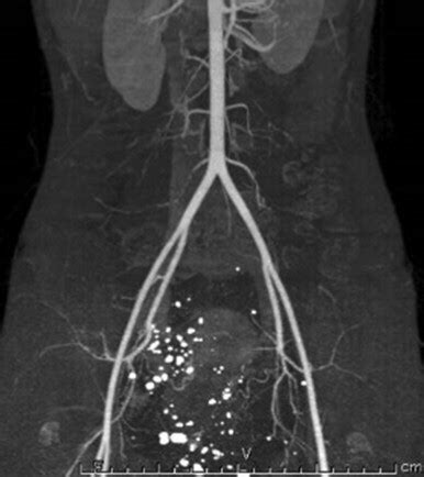 3D CT. A contrast-enhanced 3D CT scan showed perirectal phleboliths. | Download Scientific Diagram