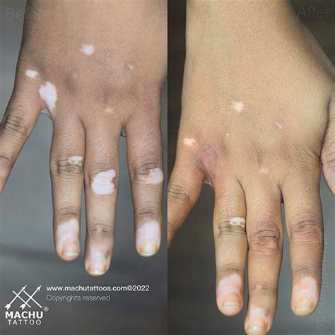 Vitiligo Treatment Bangalore, Permanent Skin Color Treatment