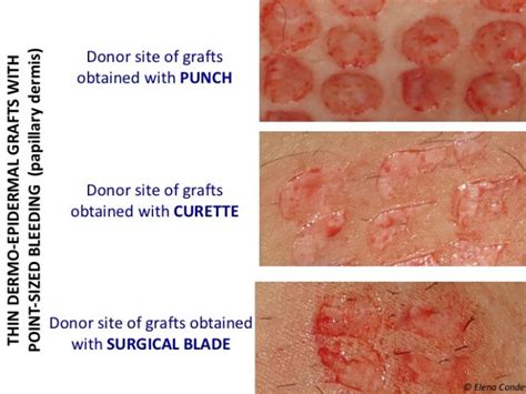 Which dressing should I choose to cover the skin graft donor site?