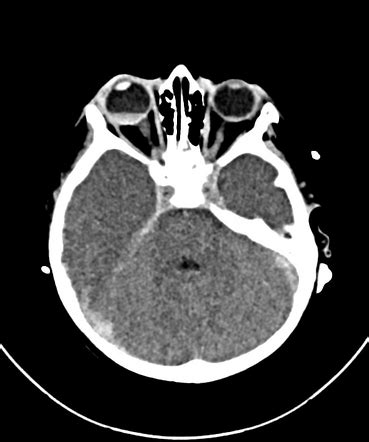 Vitreous hemorrhage | Radiology Reference Article | Radiopaedia.org