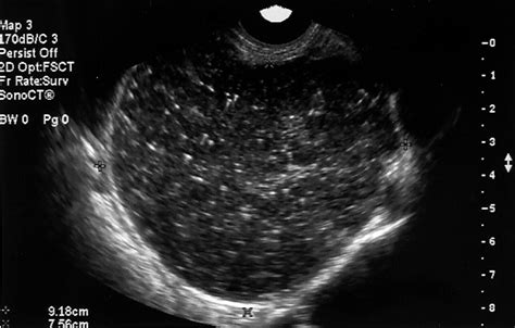 cystadenocarcinoma Serous Cystadenocarcinoma Ovary Ultrasound Ovary ultrasound serous ...