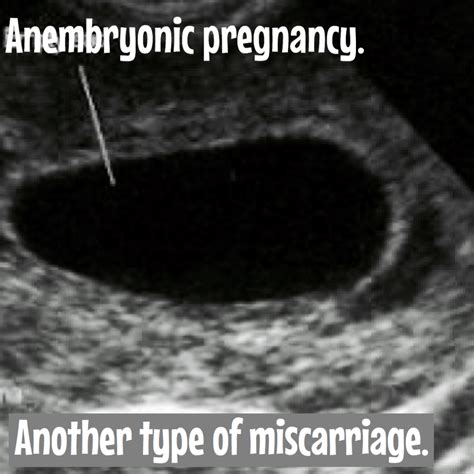 All you need to know about miscarriages. - Ultrasoundfeminsider