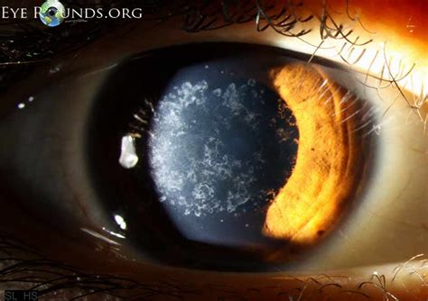 Granular corneal dystrophy type 1: The University of Iowa, Ophthalmology