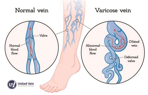 What Causes Swollen Veins? | UVVC