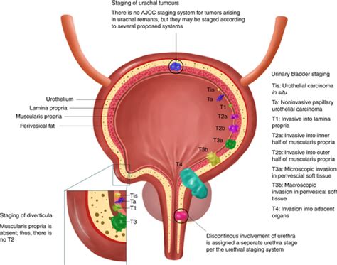 Staging of bladder cancer - Magers - 2019 - Histopathology - Wiley Online Library