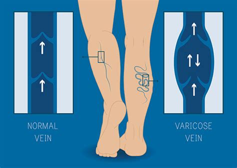 Lower Extremity Venous with Reflux Ultrasound | Cardiovascular Institute of the Shoals