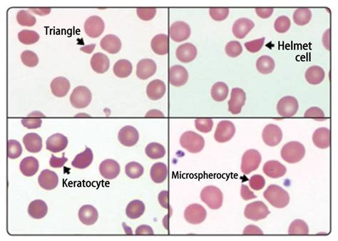 Schistocytes shapes according to ICSH | Study materials, Human anatomy ...