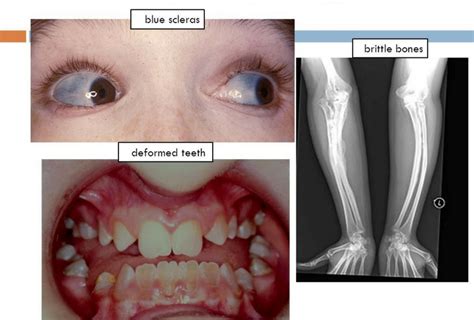 Pediatric Orthopedics | Managing Osteogenesis Imperfecta | Col (Dr) Adari