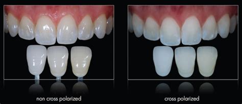 Utility of Cross-Polarized Photography in Dental Shade Matching - Decisions in Dentistry