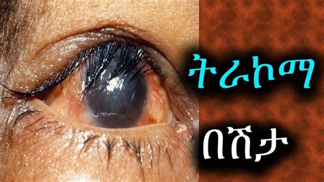 Trachoma trachomatis, causes, pictures, disease, prevention, meaning, 2019 in Ethiopia - YouTube