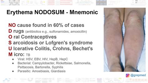 Causes of Erythema Nodosum - Mnemonic NO cause found ... | GrepMed