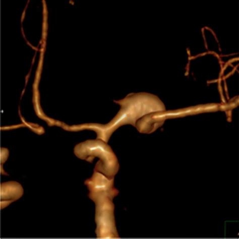 An example of an anterior view of a 3D rendered MCA proximal aneurysm... | Download Scientific ...