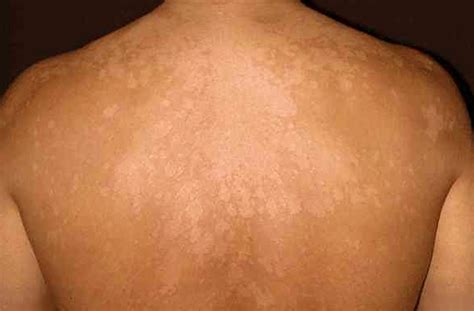 Tinea Versicolor - Pictures, Contagious, Symptoms, Treatment - (2018 - Updated)