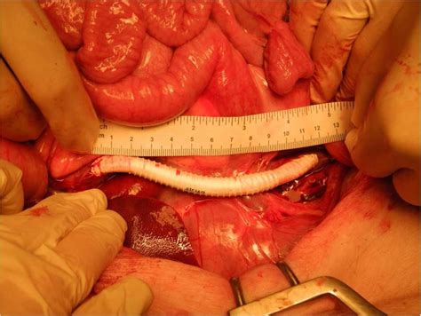 6: The end to side anastomosis of the portosystemic shunt is measured ...