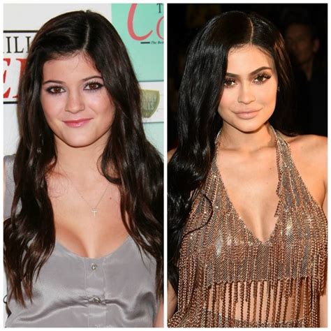 Kylie Jenner Before and After Plastic Surgery Photos Reveal Drastic ...