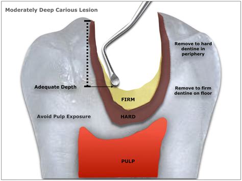 Carious tissue removal in a moderately deep carious lesion | Download Scientific Diagram