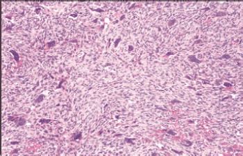 Ossifying Fibroma Histology