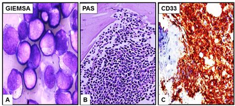 Cancers | Special Issue : Cancer-Associated Fibroblasts