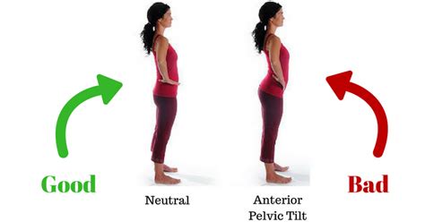 Anterior Pelvic Tilt: What It Is & How To Fix It. - Complete Fitness Design