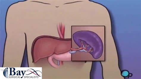 Splenectomy - Surgical Removal of the Spleen - YouTube