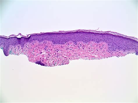 Fibrous Papule Histology